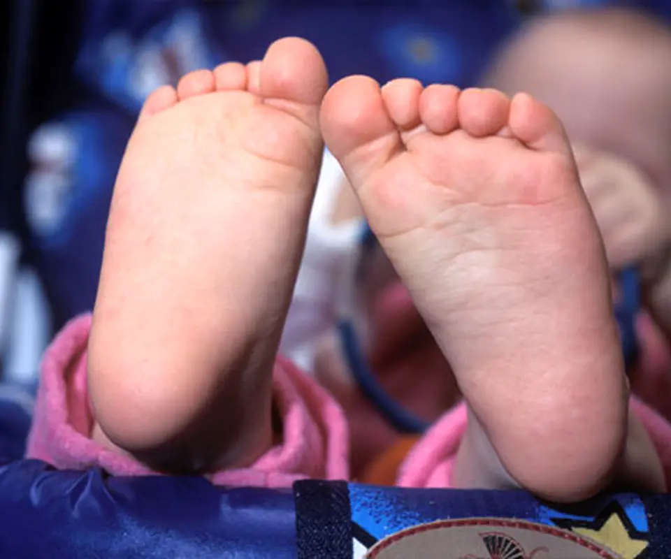 صافی کف پا در کودکان، ارثی است؟