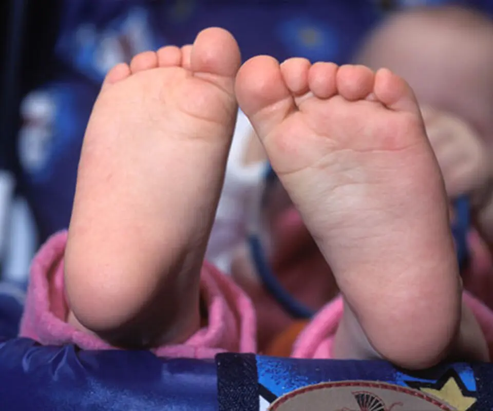 صافی کف پا در کودکان، ارثی است؟