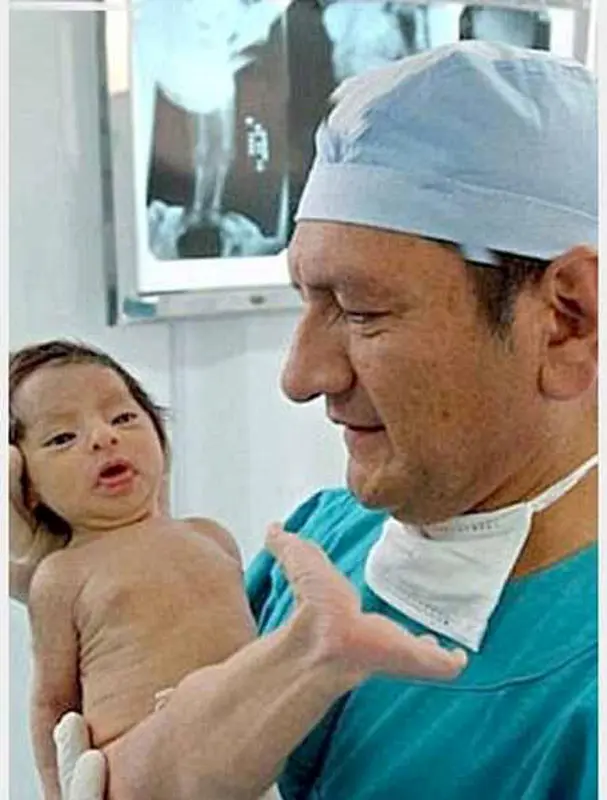 کودک شبیه پری دریایی، مبتلا به سندرومی نادر