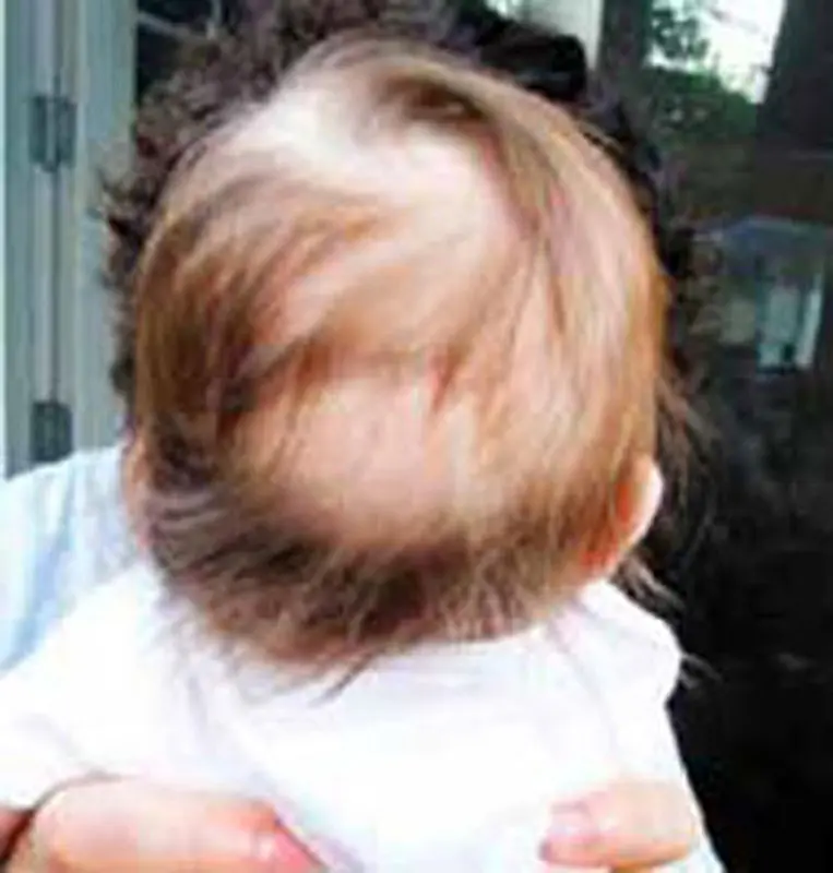 آلوپسی آره آتا در کودکان، باعث چیست؟