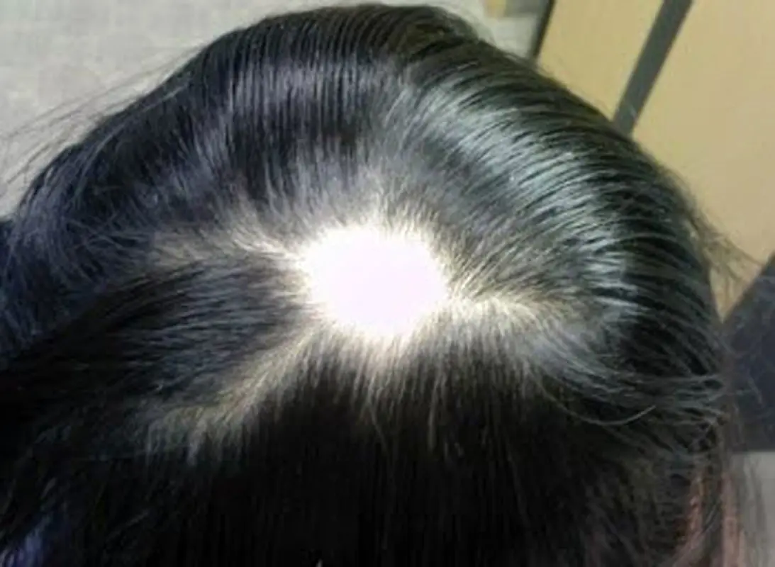 علت ریزش موی کودکان چیست؟