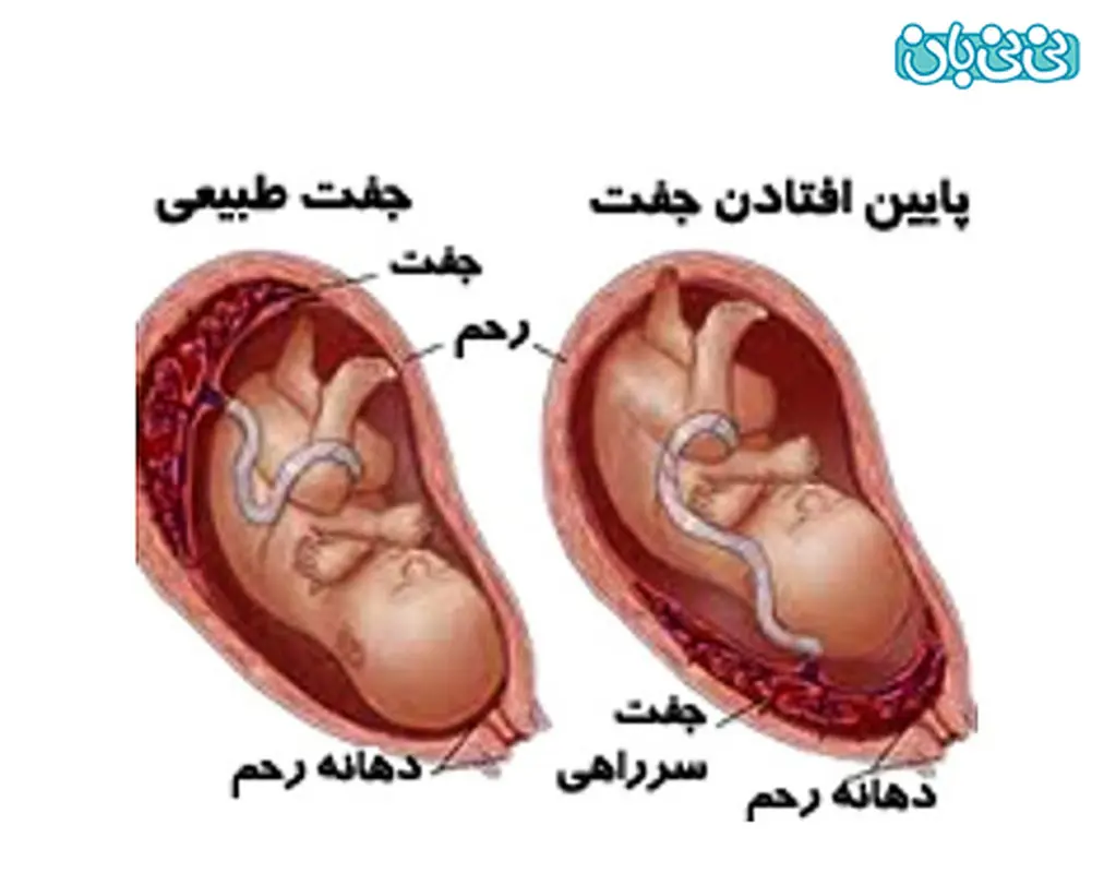نگران پایین بودن جفت نباشید