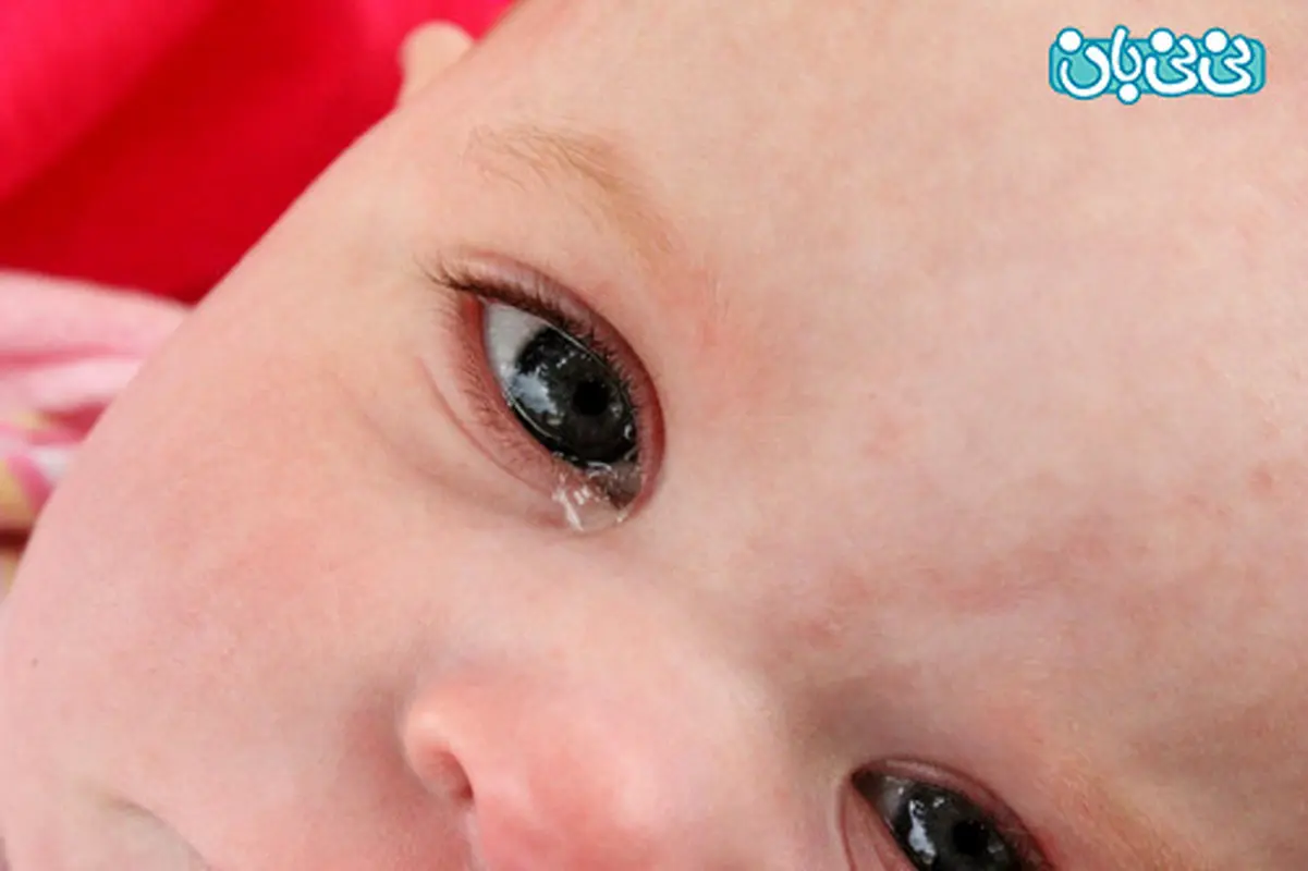 گرفتگی مجرای اشکی چشم، هنگام تولد