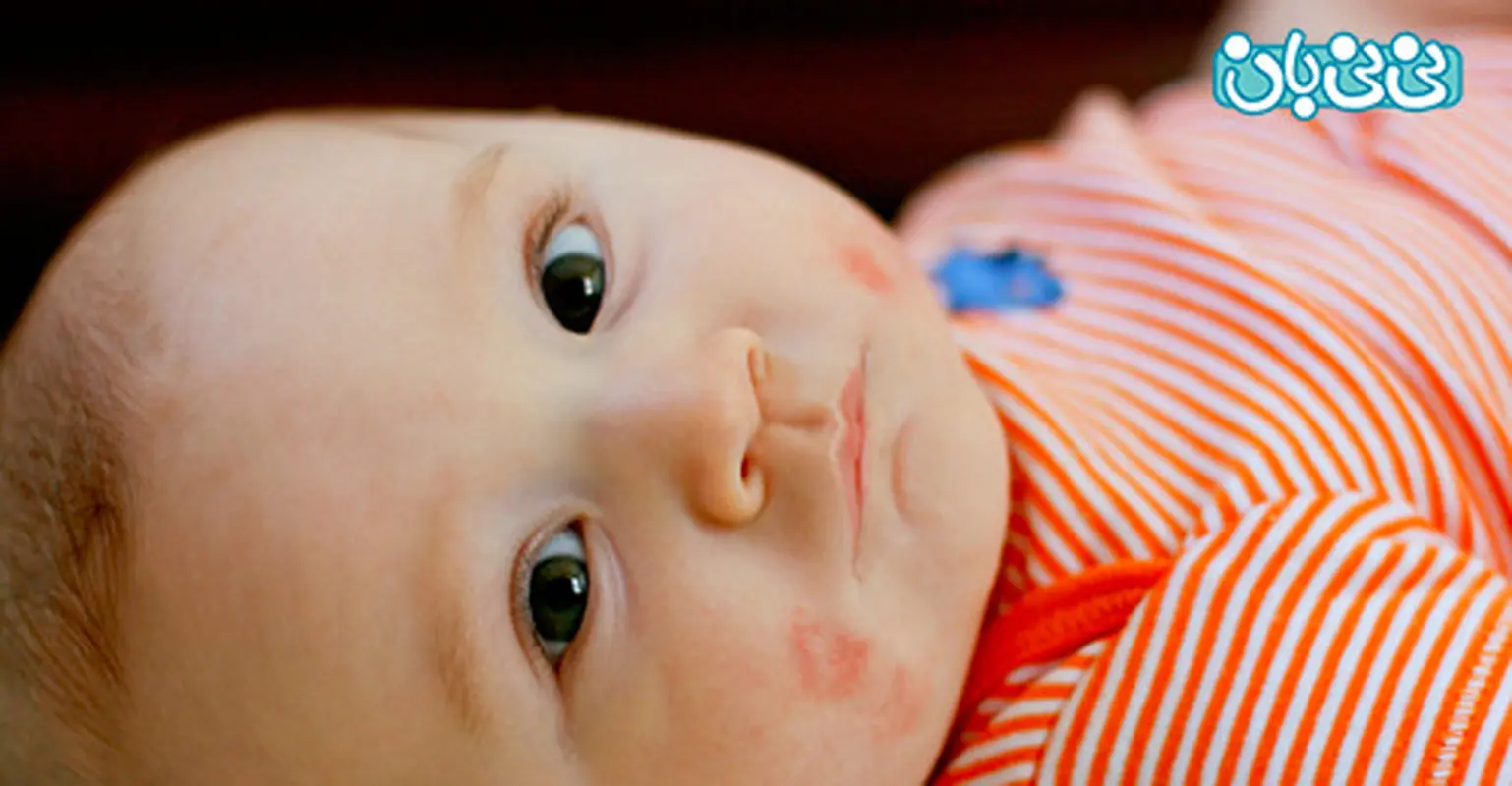 آیا کودکم آلرژی غذایی دارد؟ (2)