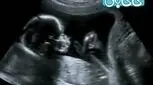 حرکات جنین در رحم، از سه ماهه اول تا سوم (3)