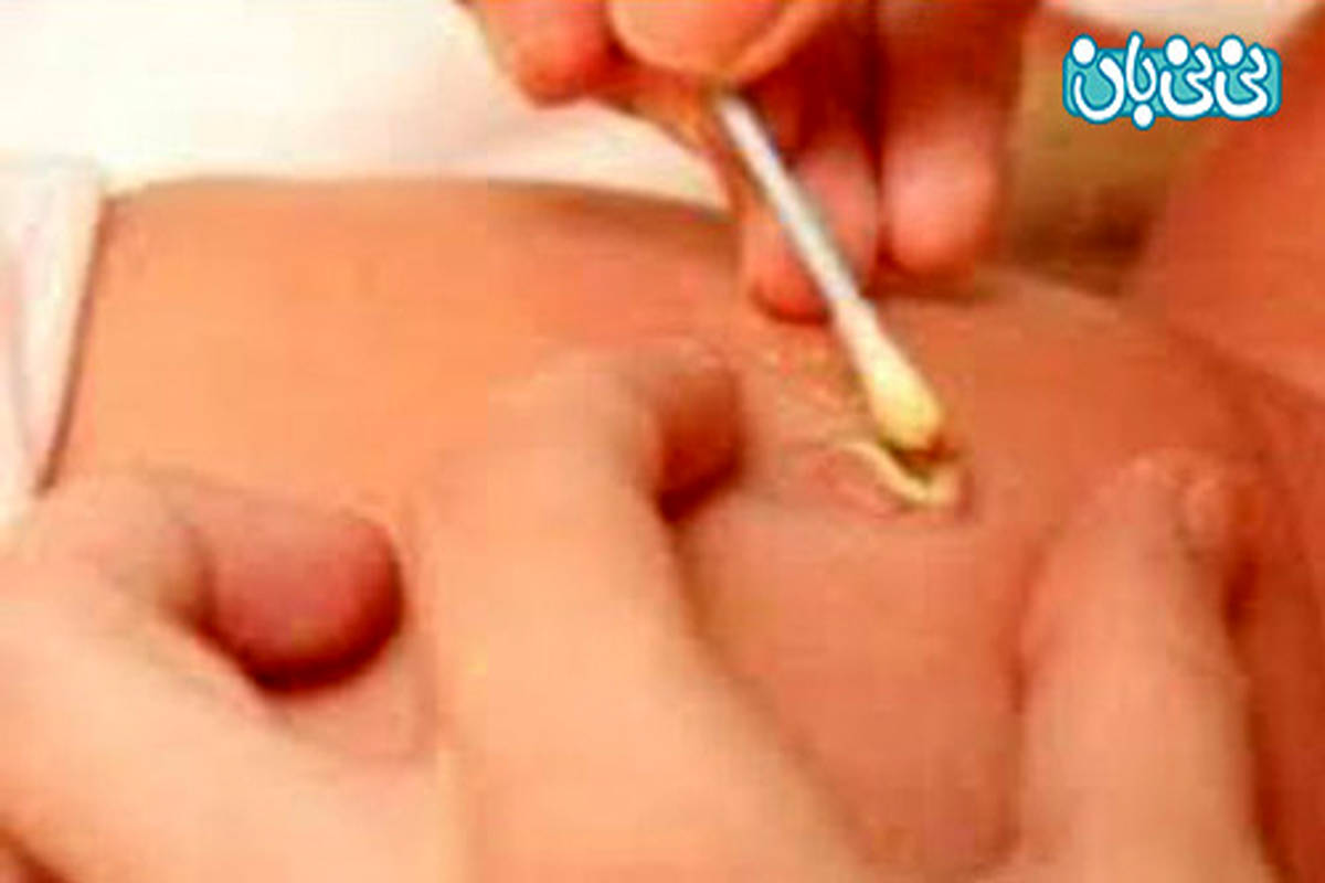 با بند ناف نوزاد چه کنیم؟