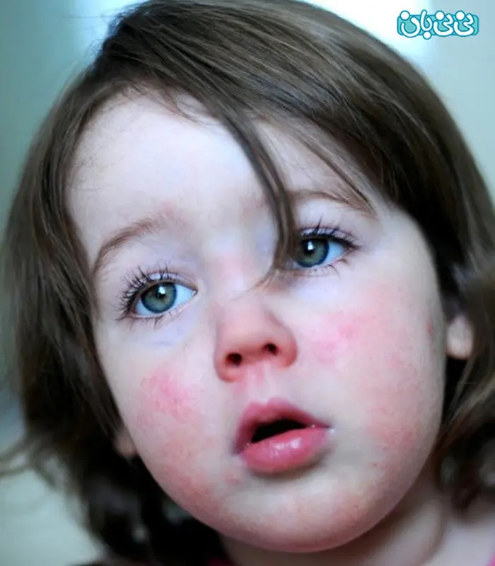 بیماری مخملک کودکان، علت ابتلا