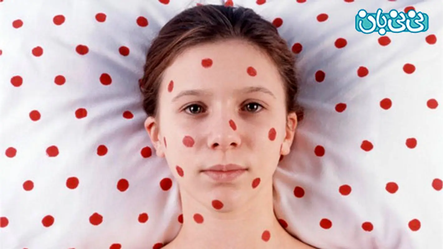 بیماری سرخک کودکان، امید به ریشه‌کنی