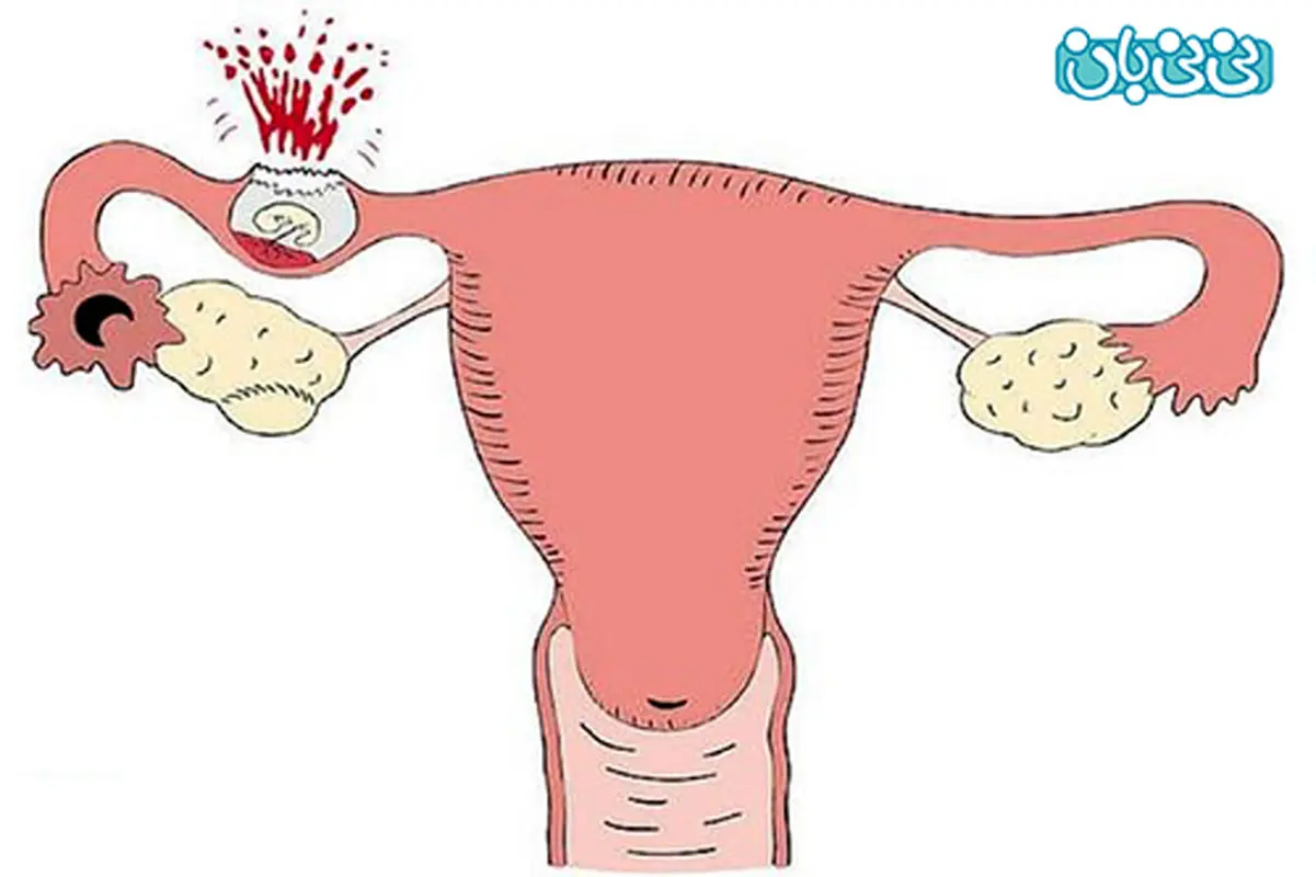 اقدام مجدد بعد حاملگی خارج رحمی