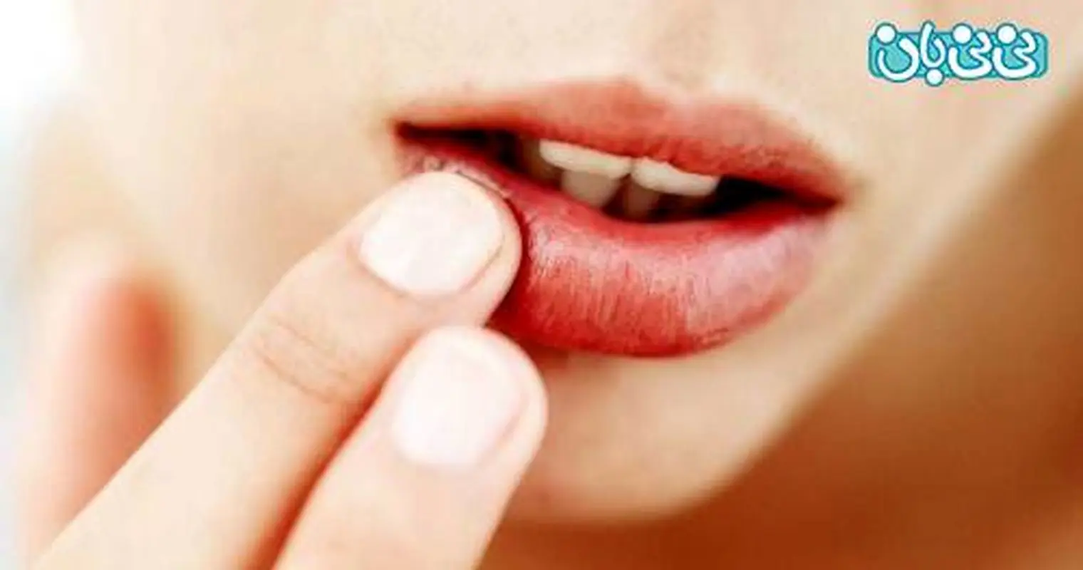 تبخال لب در بارداری، طریقه درمان