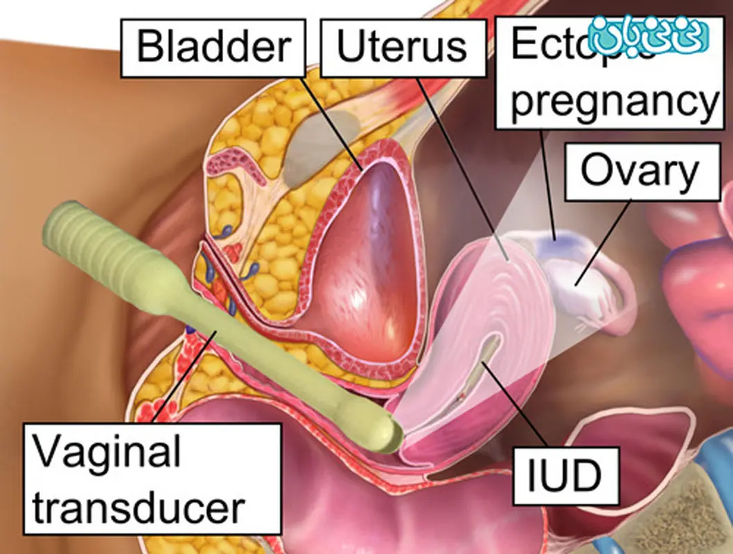 بارداری خارج از رحم چگونه است؟