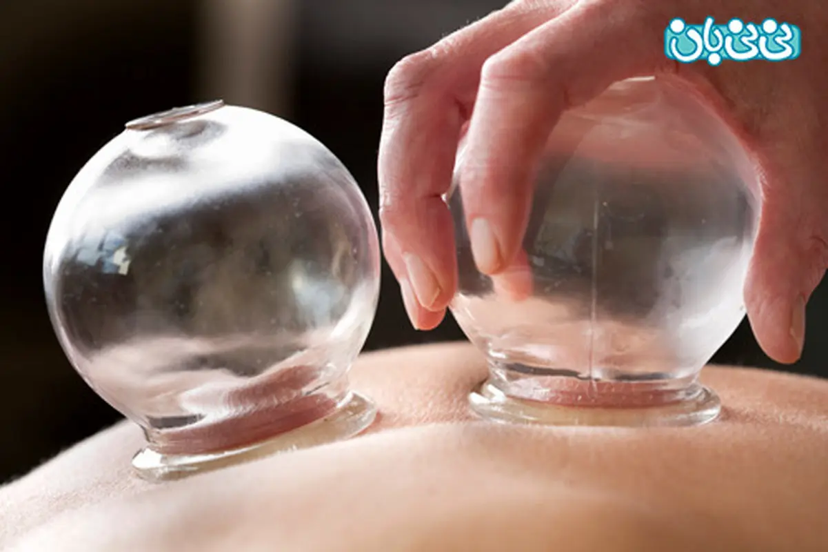 آیا حجامت مفید است؟