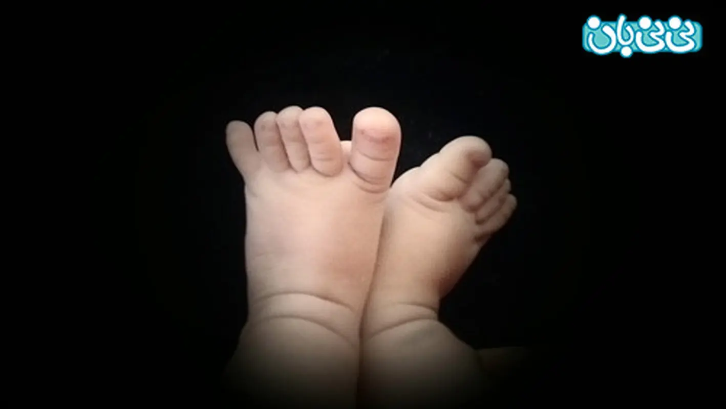 پای پرانتزی در کودکان، شایع‌ ترین عامل ها