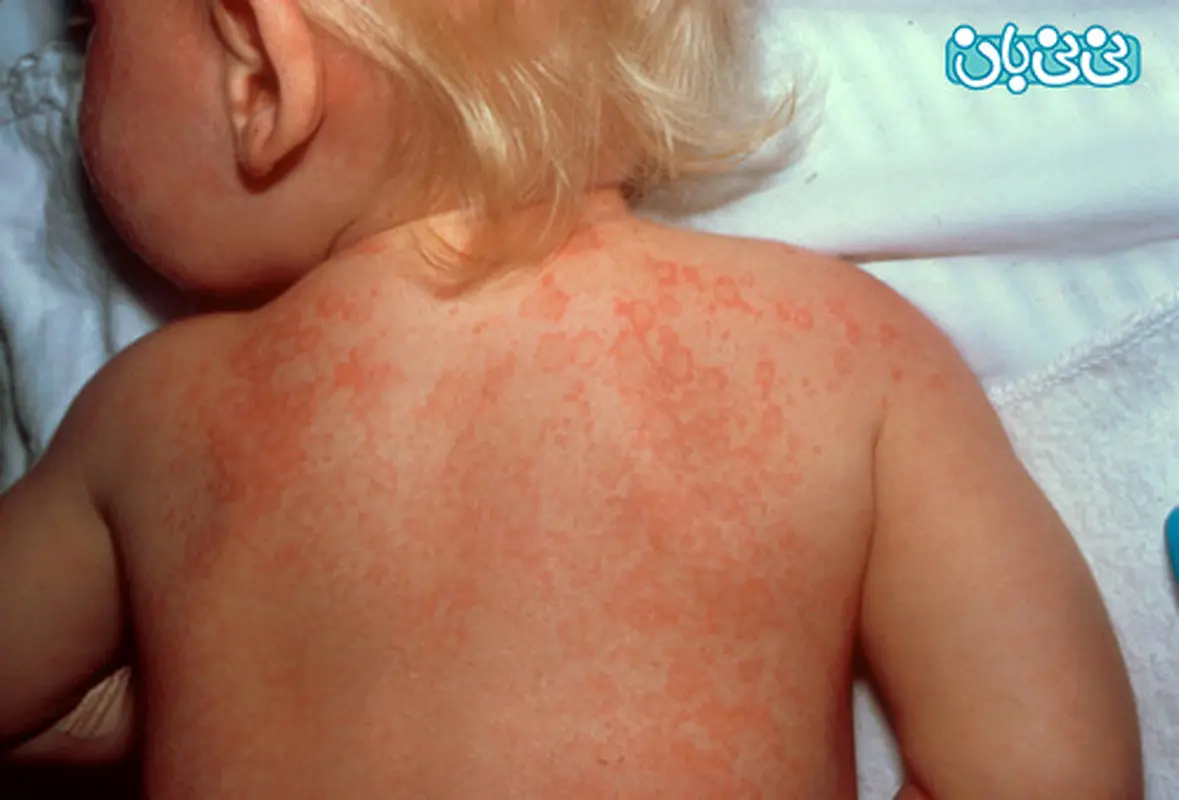 بیماری کاواساکی کودکان، چیست؟