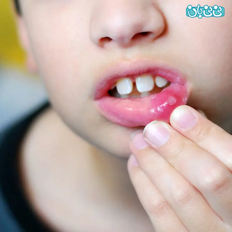 زخم های دهانی کودکان، چرا به وجود می‌آید؟