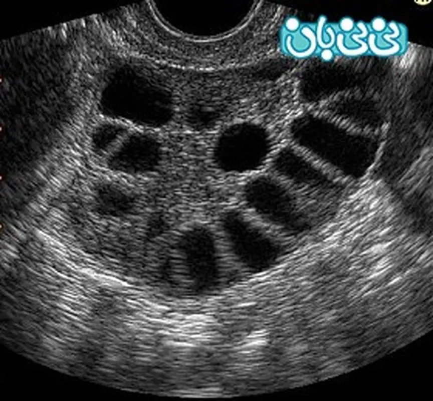 تنبلی تخمدان و همه حواشی آن