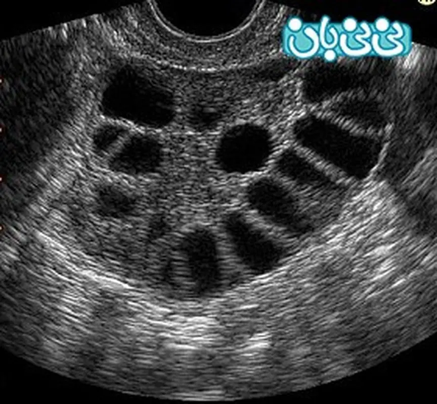 تنبلی تخمدان و همه حواشی آن