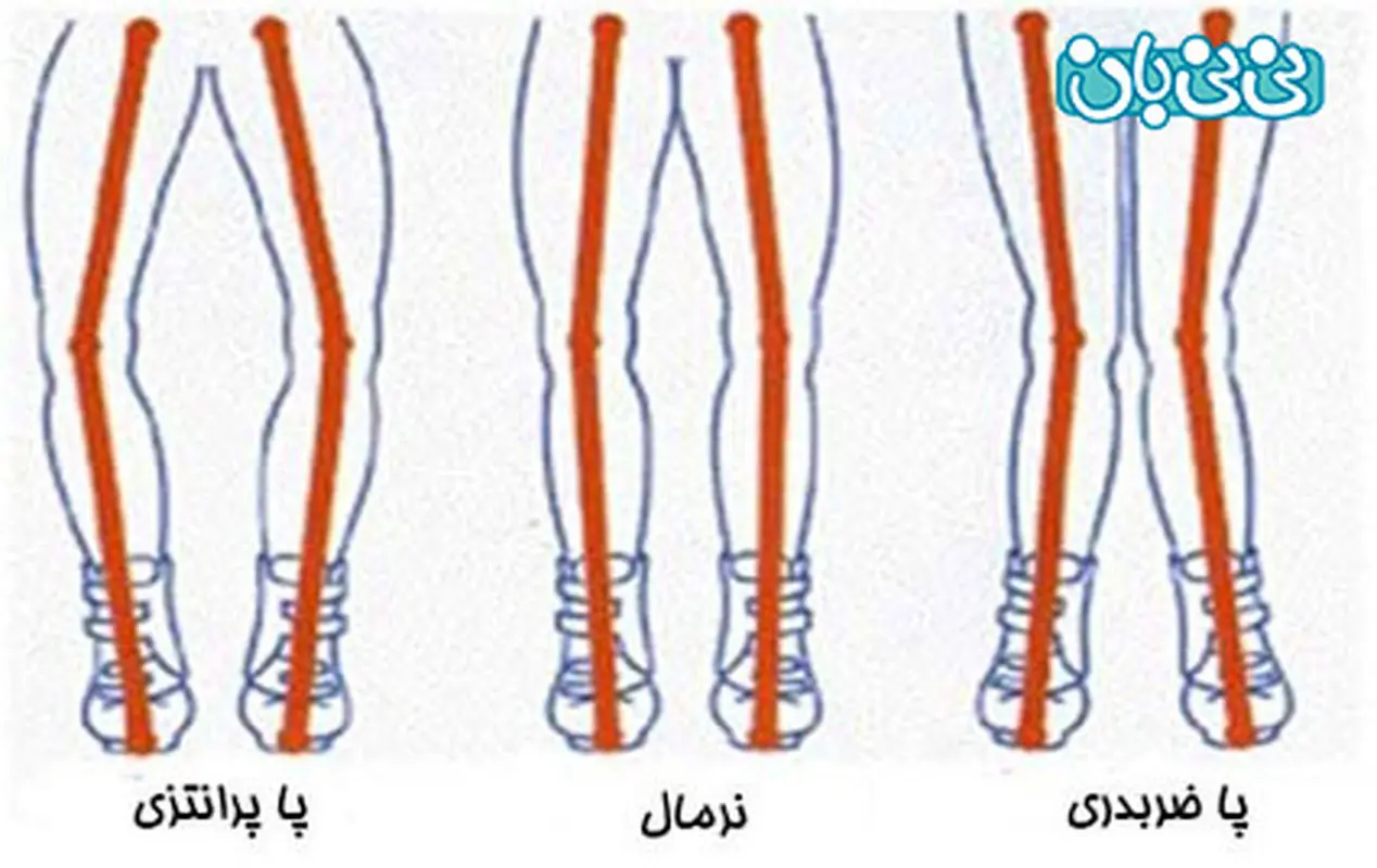 مشکل پا پرانتزی در کودکان، علت