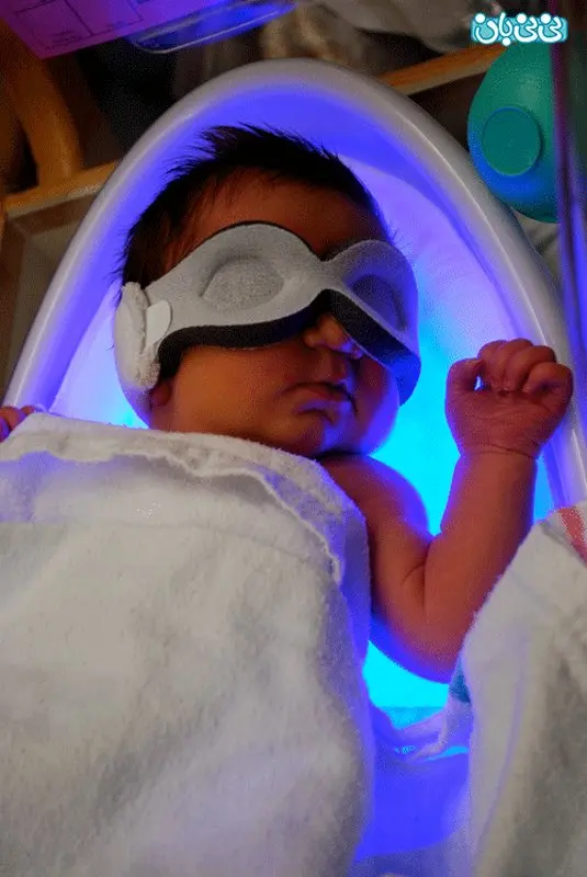 دلیل بروز زردی در نوزادان