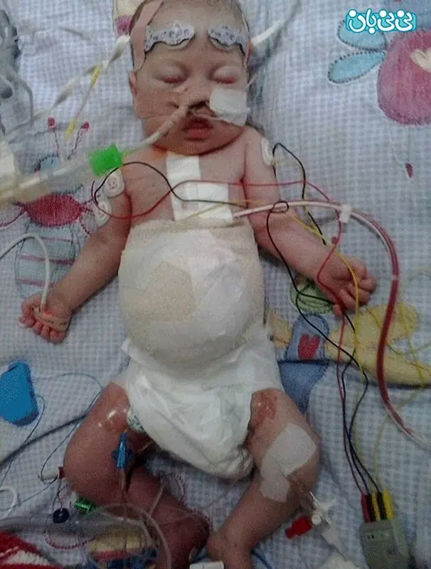 تولد نوزاد عجیب، معده خارج از بدن