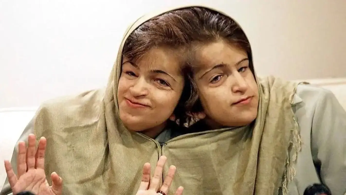 عکس‌هایی از کودکی دوقلوهای بهم چسبیده لاله و لادن که ندیده‌اید! رازهایی از زندگی تا سنگ قبرشان