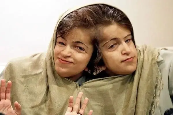 عکس‌هایی از کودکی دوقلوهای بهم چسبیده لاله و لادن که ندیده‌اید! رازهایی از زندگی تا سنگ قبرشان