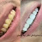 کامپوزیت ونیر دندان چیست؟ هزینه کامپوزیت دندان