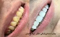 کامپوزیت ونیر دندان چیست؟ هزینه کامپوزیت دندان