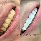 کامپوزیت ونیر دندان چیست؟ هزینه کامپوزیت دندان