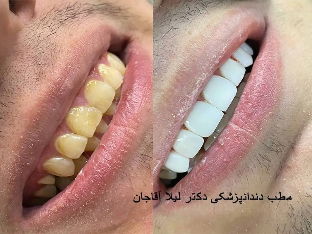 کامپوزیت ونیر دندان چیست؟ هزینه کامپوزیت دندان