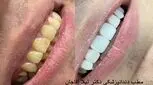 کامپوزیت ونیر دندان چیست؟ هزینه کامپوزیت دندان