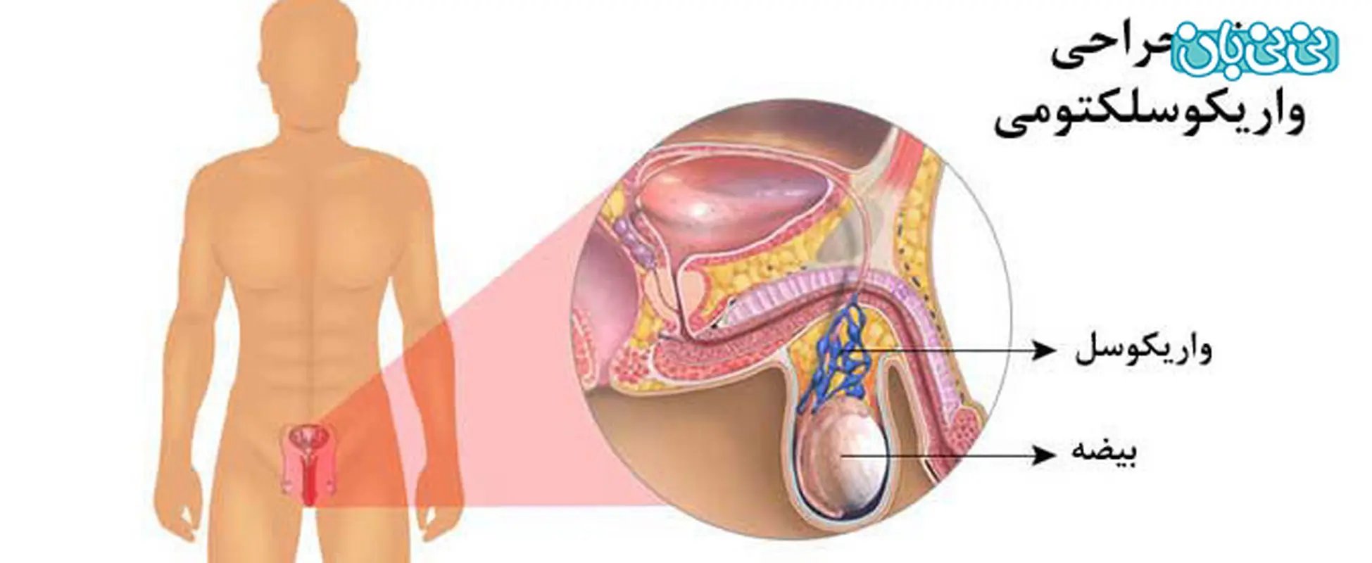همسرم واریکوسل عمل کرده کی نزدیکی داشته باشیم؟