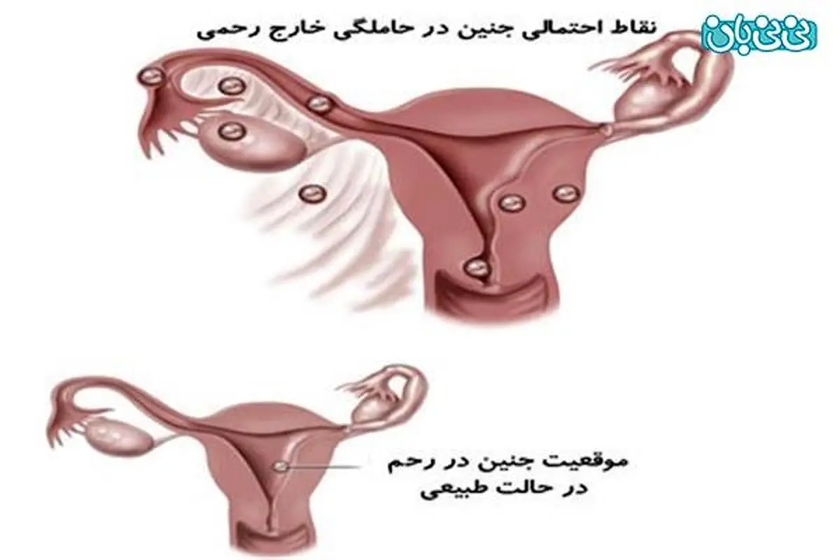 حاملگی خارج رحم در آزمایش خون نشان داده می شود؟