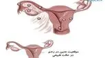 حاملگی خارج رحم در آزمایش خون نشان داده می شود؟