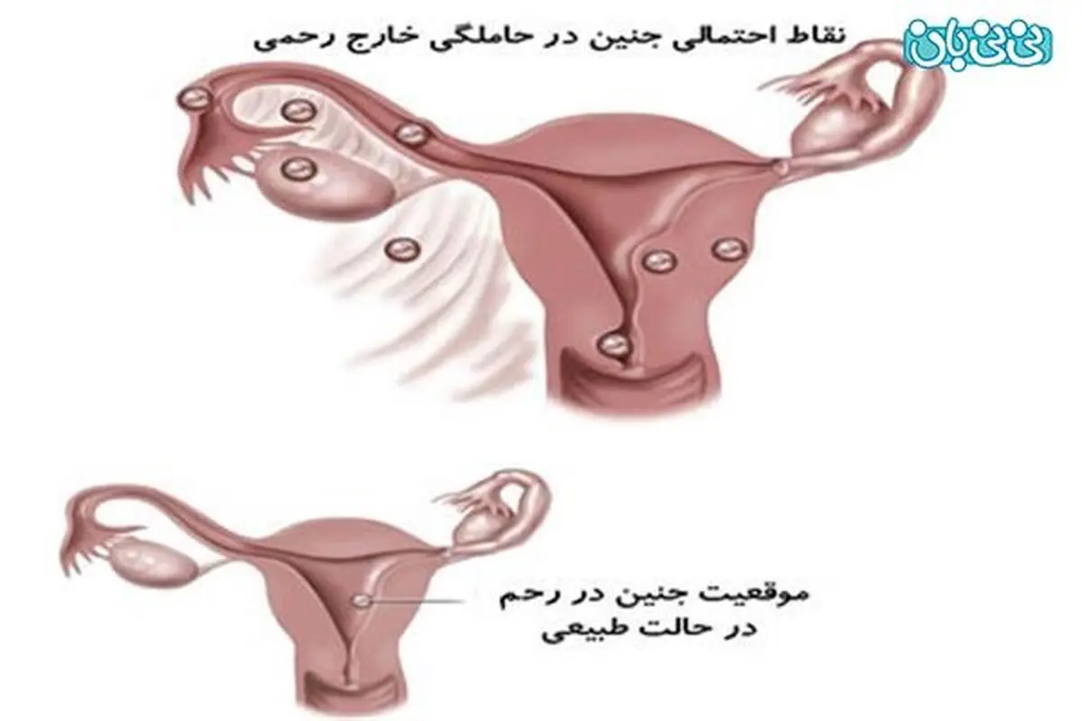 حاملگی خارج رحم در آزمایش خون نشان داده می شود؟