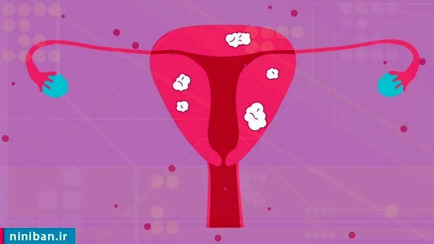 درمان میوم چیست؟