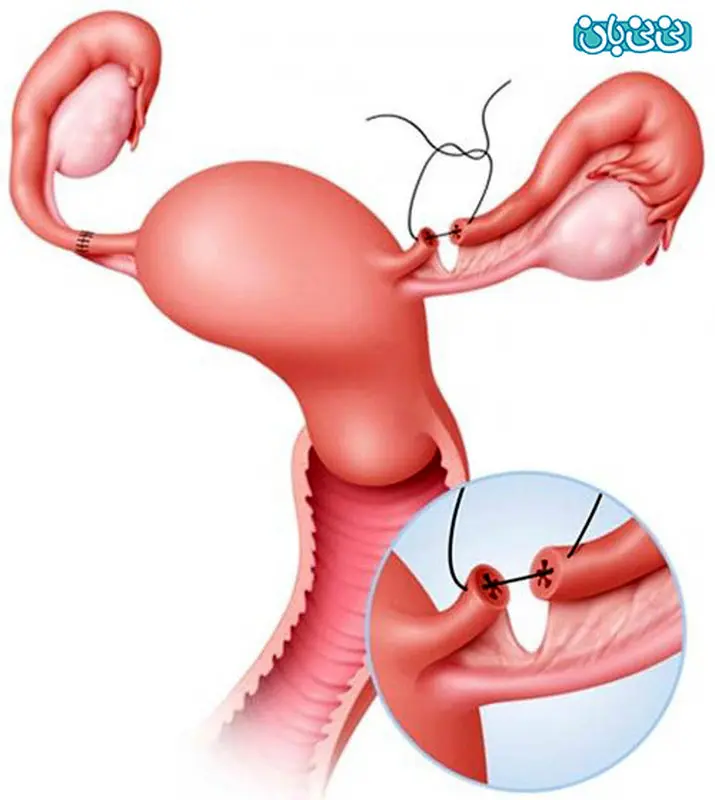 بستن لوله های رحمی، باعث اختلال قاعدگی می‌شود؟