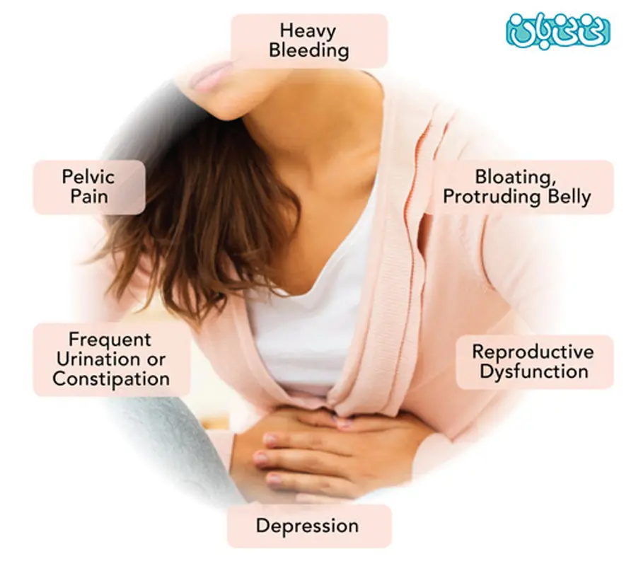 فیبروم رحمی و بارداری (2)