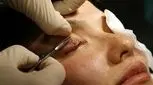 جراحی کاشت مژه چیست و چقدر ماندگاری دارد؟
