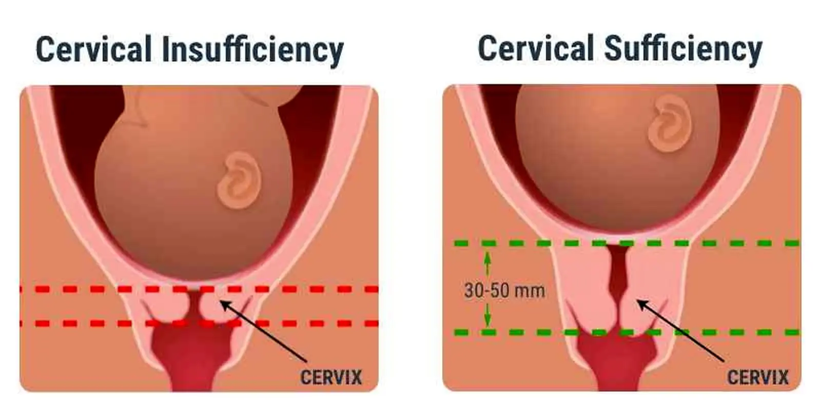 کوتاهی دهانه رحمم با استراحت رفع می شود؟