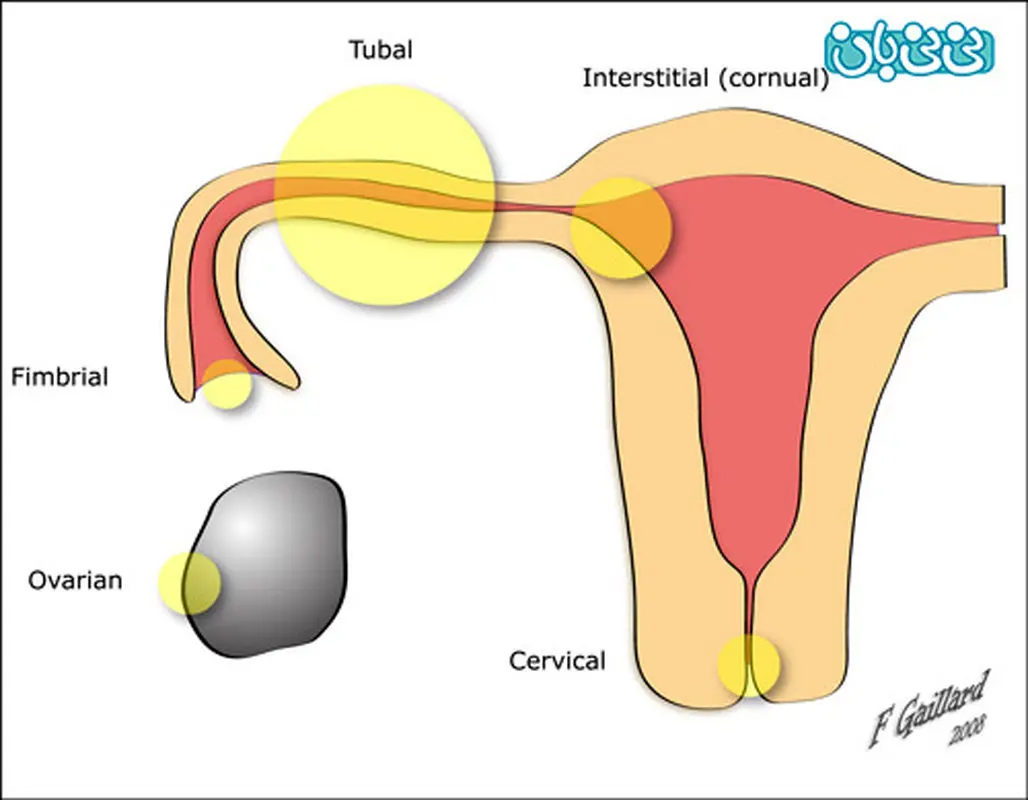 نشانه های بارداری خارج از رحم(1)