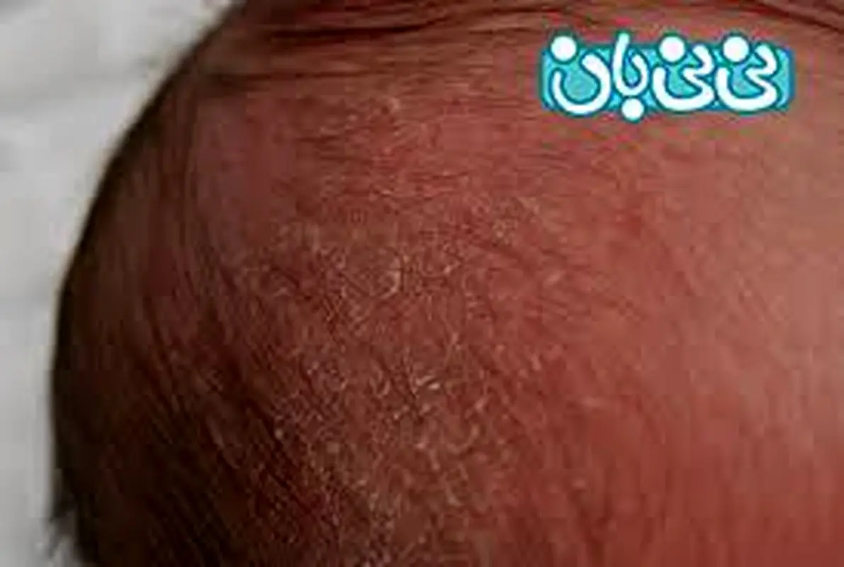 پوست پوست شدن سر نوزاد، راه حل چیست؟