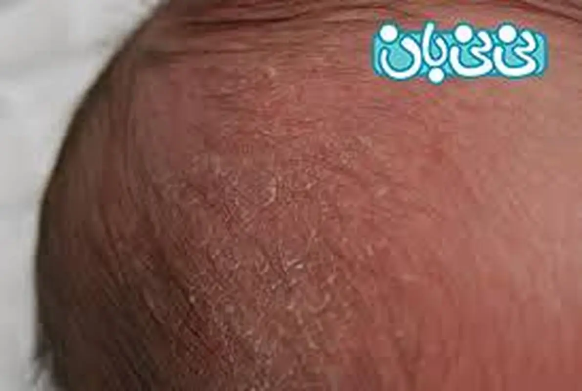 پوست پوست شدن سر نوزاد، راه حل چیست؟