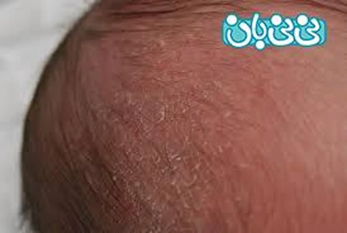 پوست پوست شدن سر نوزاد، راه حل چیست؟