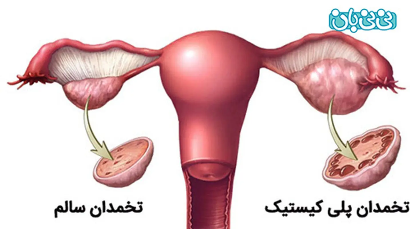 بزرگ شدن تخمدانها نشانه چیست؟