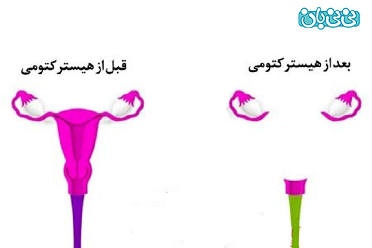 رابطه جنسی پس از برداشتن رحم