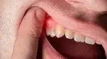 باکتری بیماری لثه می‌تواند به قلب بزند