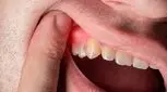 باکتری بیماری لثه می‌تواند به قلب بزند