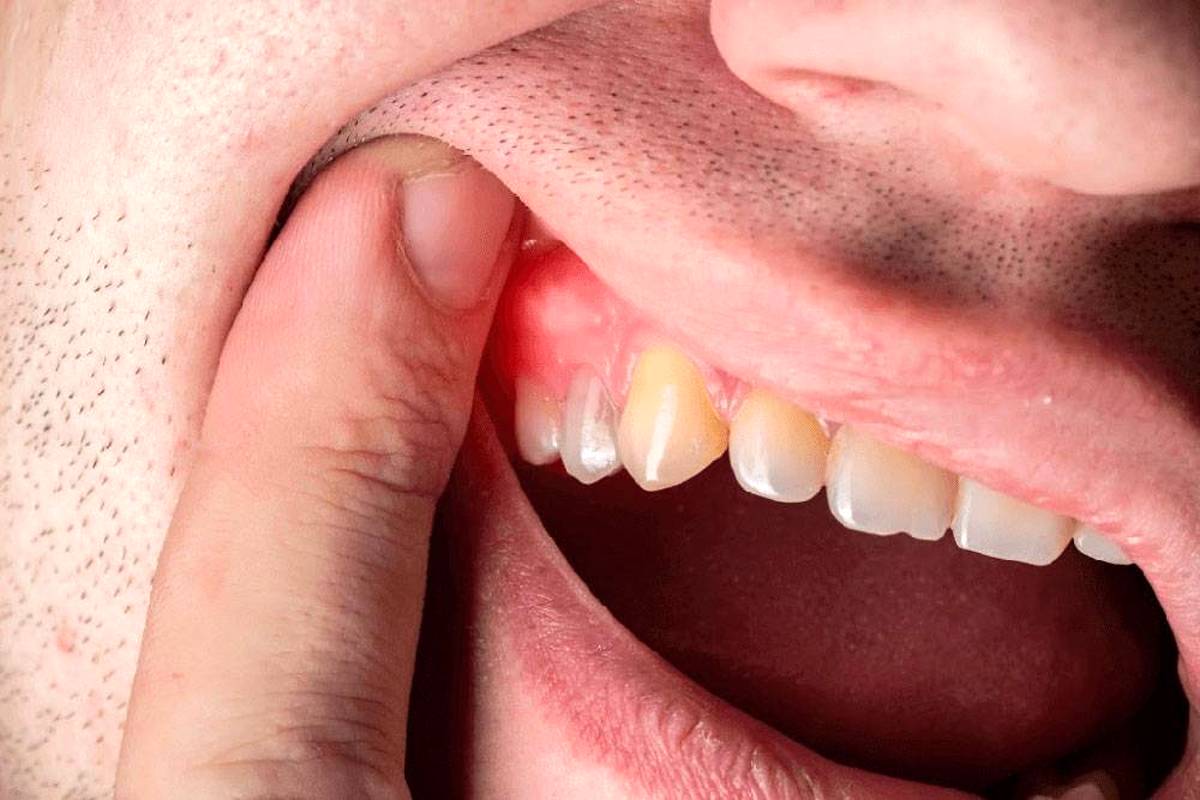 باکتری بیماری لثه می‌تواند به قلب بزند