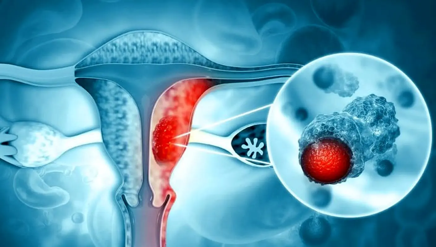 سرطان رحم و hpv
